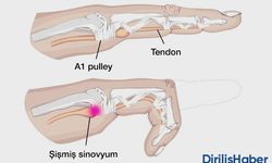 Parmak Tendon Kopması Ne Kadar Sürede İyileşir?