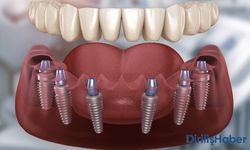 All on 6 İmplant Tedavisi Nedir? Neden Yaptırmalısınız?