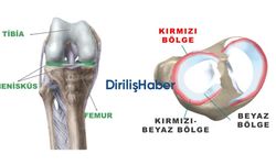 Menisküs Yırtığı Kaç Ayda İyileşir?