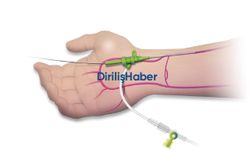 Bilekten Anjiyo Sonrası Dikkat Edilmesi Gerekenler