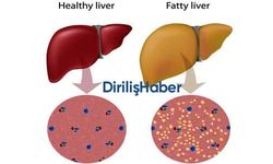 Karaciğer Yağlanmasına Ne İyi Gelir?