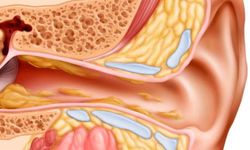 Kulak İltihabına Ne İyi Gelir?