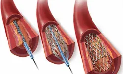 Anjiyo Stent Sonrası Dikkat Edilmesi Gerekenler Nelerdir?