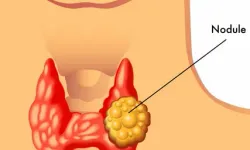Boğazdaki Nodüller Ne İyi Gelir?