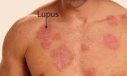 Lupus Hastalığı Nedir? Belirtileri ve Tedavisi