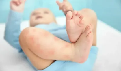 Bebeklerde Alerji Belirtileri! Bir şeye alerji olduğu nasıl anlaşılır?