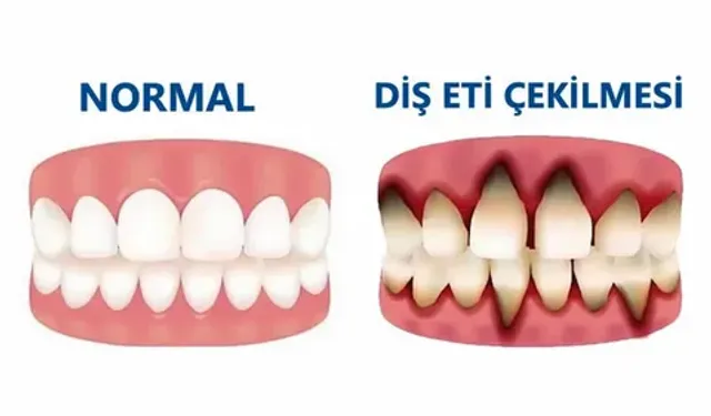 Diş Eti Çekilmesine Ne İyi Gelir?