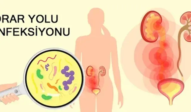 Kadınlarda İdrar Yolu Enfeksiyonuna Ne İyi Gelir?