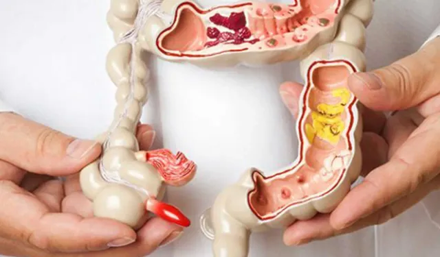 Crohn Hastalığı Nedir? belirtileri nelerdir?