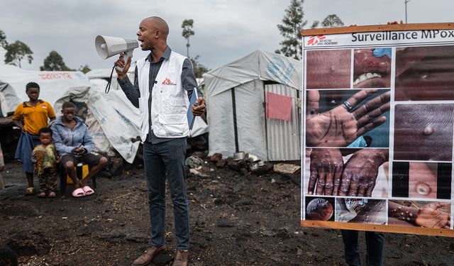 Kongo'da M çiçeği virüsü vaka sayısında artış