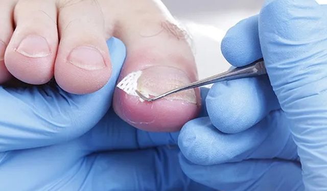 Tırnak mantarını önlemek için yapılması gerekenler
